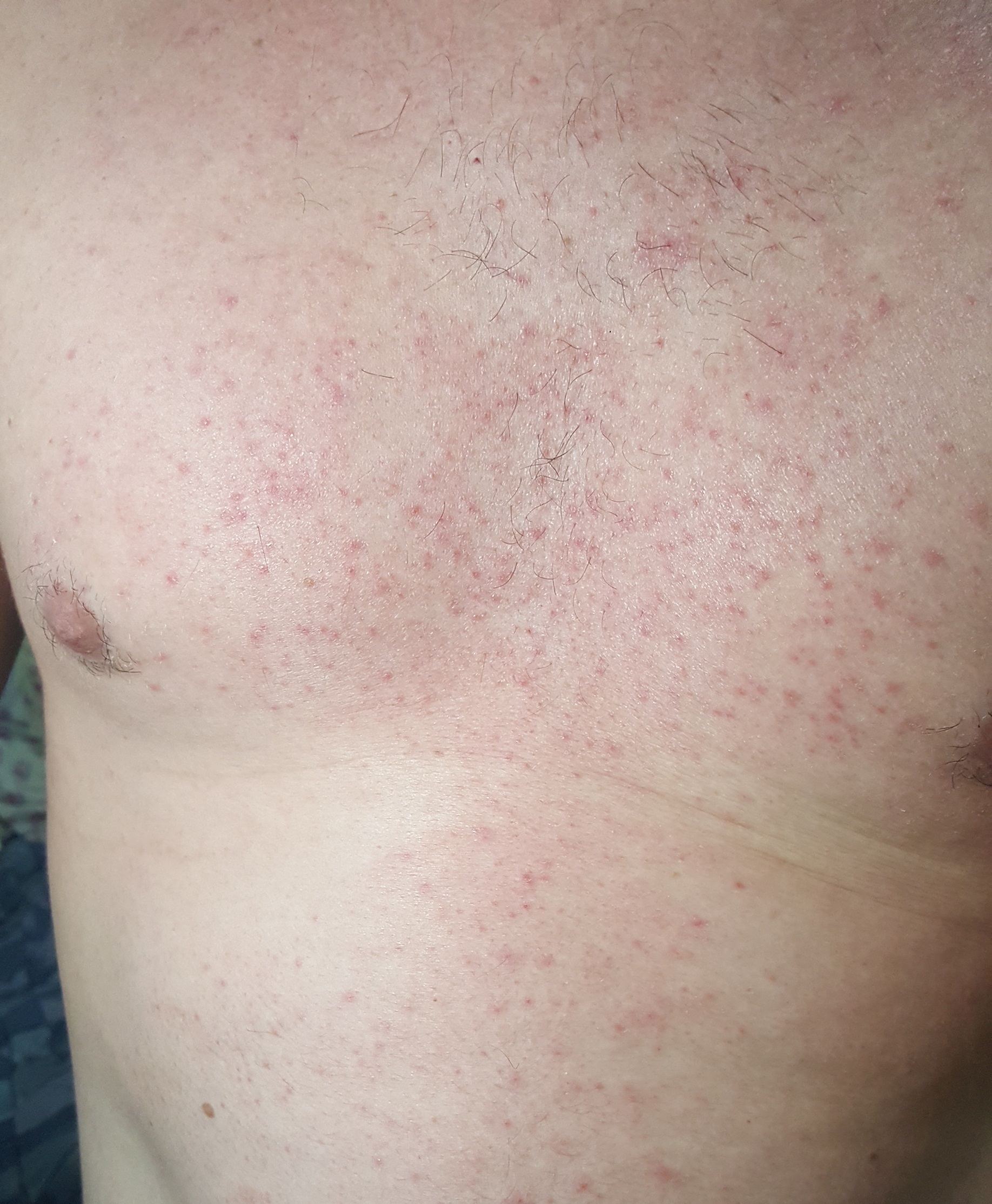 Peito e tronco com foliculite antes do Tend Skin — inflamação e bolinhas vermelhas